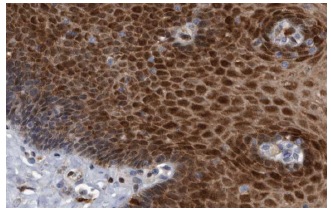 SerpinB8 (PI-8): sc-101371. Immunoperoxidase staining of formalin fixed, paraffin-embedded human esophagus showing nuclear and cytoplasmic staining of squamous epithelial cells at high magnification. Kindly provided by The Swedish Human Protein Atlas (HPA) program.