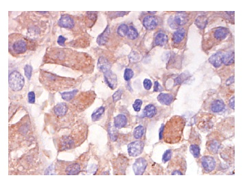Shc (C-20): sc-288. Immunoperoxidase staining of formalin-fixed, paraffin-embedded human pancreas tumor showing cytoplasmic staining.