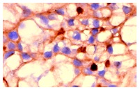 SIRP-α/β (A-1): sc-17803. Immunoperoxidase staining of formalin fixed, paraffin-embedded human kidney tumor showing membrane localization.