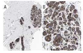 SQSTM1 (D-3): sc-28359. Immunoperoxidase staining of formalin fixed, paraffin-embedded human breast tissue showing cytoplasmic staining of glandular cells at low (A) and high (B) magnification. Kindly provided by The Swedish Human Protein Atlas (HPA) program.