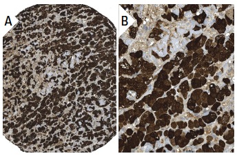SULT2A1 (FL-285): sc-32941. Immunoperoxidase staining of formalin fixed, paraffin-embedded human adrenal gland tissue showing cytoplasmic and nuclear staining of cortical cells at low (A) and high (B) magnification. Kindly provided by The Swedish Human Protein Atlas (HPA) program.