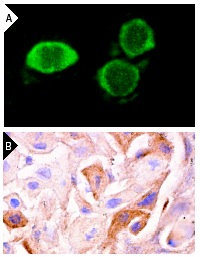TAB2 (K-20): sc-11851. Immunofluorescence staining of methanol-fixed A-431 cells (A) and immunoperoxidase staining of formalin-fixed, paraffin-embedded human lung tumor (B) showing cytoplasmic staining.
