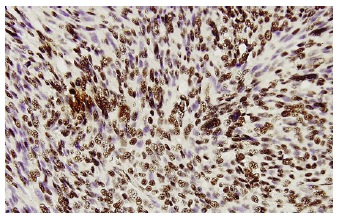 TARDBP (41-7.1): sc-100871. Immunoperoxidase staining of formalin-fixed, paraffin-embedded human leiomyosarcoma tissue showing nuclear localization.
