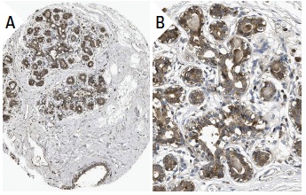 Thrombin API (H-85): sc-33769. Immunoperoxidase staining of formalin fixed, paraffin-embedded human breast tissue showing cytoplasmic staining of glandular cells (low and high magnification). Kindly provided by The Swedish Human Protein Atlas (HPA) program.