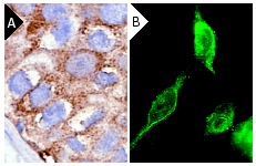 TRAP-1 (C-18): sc-8665. Immunoperoxidase staining of formalin-fixed, paraffin-embedded human breast tumor (A) and immunofluorescence staining of methanol-fixed MIA PaCa-2 cells (B) showing cytoplasmic localization.