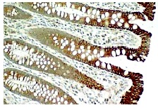 Amphiphysin II (2F11): sc-23918. Immunoperoxidase staining of formalin fixed, paraffin-embedded human colon tissue showing cytoplasmic Amphiphysin II isoform expression. Kindly provided by Dr. George Prendergast at Jefferson Medical School, Thomas Jefferson University.
