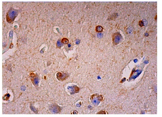 Amphiphysin II (N-19): sc-8534. Immunoperoxidase staining of formalin fixed, paraffin-embedded human cerebral cortex tissue showing cytoplasmic staining of neuronal cells and glial cells.