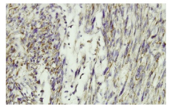 DRP1 (6Z-82): sc-101270. Immunoperoxidase staining of formalin-fixed, paraffin-embedded human leiomyosarcoma tissue showing cytoplasmic localization.