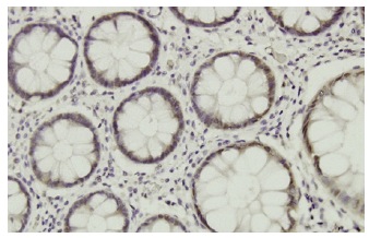 20S Proteasome α7 (GH6): sc-100456. Immunoperoxidase staining of formalin-fixed, paraffin-embedded human lung, adenosqumous cell carcinoma tissue showing nuclear and cytoplasmic localization.