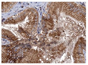 Calpain 3 (H-80): sc-50334. Immunoperoxidase staining of formalin fixed, paraffin-embedded human gail bladder tissue showing cytoplasmic staining of glandular cells at high magnification. Kindly provided by The Swedish Human Protein Atlas (HPA) program.