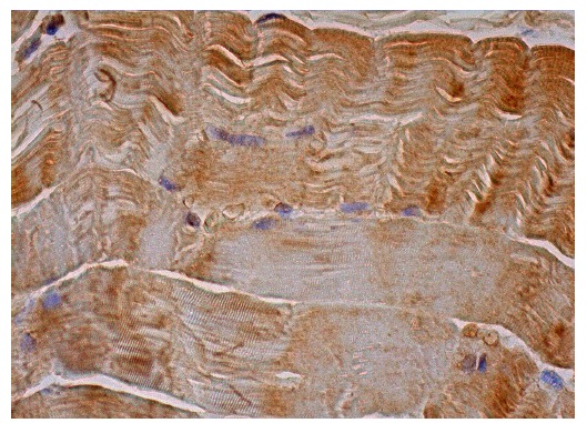 Calpain 3 (H-80): sc-50334. Immunoperoxidase staining of formalin fixed, paraffin-embedded human skeletal muscle tissue showing cytoplasmic staining of myocytes.