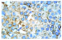 Flt-4 (C-20): sc-321. Immunoperoxidase staining of formalin-fixed, paraffin-embedded human breast carcinoma tissue showing membrane and cytoplasmic localization.