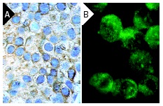 Flt-4 (C-20): sc-321. Immunoperoxidase staining of formalin-fixed, paraffin-embedded human breast carcinoma tissue (A) and immunofluorescence staining of methanol-fixed K-562 cells (B) showing membrane and cytoplasmic localization
