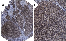 FRP-3 (H-170): sc-13941. Immunoperoxidase staining of formalin fixed, paraffin-embedded human malignant melanoma tissue showing nuclear membrane staining of tumor cells at low (A) and high (B) magnification. Kindly provided by The Swedish Human Protein Atlas (HPA) program.