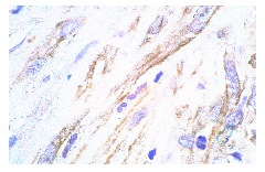 gp130 (AN-H2): sc-9994. Immunoperoxidase staining of formalin-fixed, paraffin-embedded human colon carcinoma showing cytoplasmic and membrane localization.