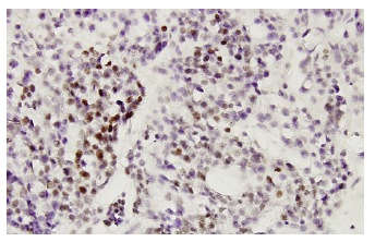 RRP9 (RS-9): sc-100592. Immunoperoxidase staining of formalin-fixed, paraffin-embedded human ovary, clear cell carcinoma tissue showing nuclear localization.