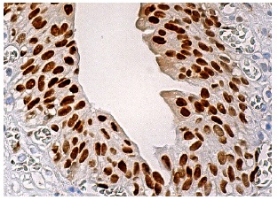 Transaldolase (H-4): sc-166230. Immunoperoxidase staining of formalin fixed, paraffin-embedded human urinary bladder tissue showing nuclear staining of urothelial cells.