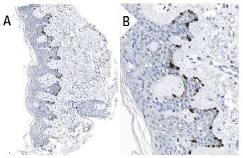 TRP2 (C-9): sc-74439. Immunoperoxidase staining of formalin fixed, paraffin-embedded human skin tissue showing cytoplasmic and membrane staining of a subset of epidermal cells (low and high magnification). Kindly provided by The Swedish Human Protein Atlas (HPA) program.
