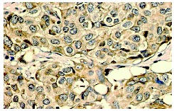 TRP2 (H-150): sc-25544. Immunoperoxidase staining of formalin fixed, paraffin-embedded human breast tumor showing cytoplasmic localization.
