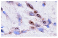 Ub (FL-76): sc-9133. Immunoperoxidase staining of formalin-fixed, paraffin-embedded human breast tumor showing cytoplasmic and nuclear staining.