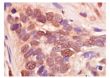 UBC9 (N-15): sc-5231. Immunoperoxidase staining of formalin-fixed, paraffin-embedded human lung tumor showing nuclear staining.