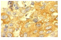 Ran GAP1 (C-5): sc-28322. Immunoperoxidase staining of formalin fixed, paraffin-embedded human breast tumor tissue showing cytoplasmic localization.