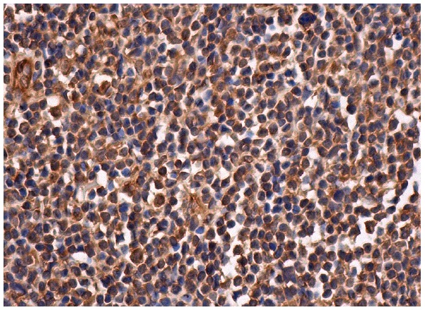 IL-1RAcP (N-20): sc-47056. Immunoperoxidase staining of formalin fixed, paraffin-embedded human lymph node tissue showing cytoplasmic staining of cells in germinal and non-germinal centers.