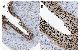 RCC1 (E-6): sc-55559. Immunoperoxidase staining of formalin fixed, paraffin-embedded human urinary bladder tissue showing nuclear staining of urothelial cells (low and high magnification). Kindly provided by The Swedish Human Protein Atlas (HPA) program.