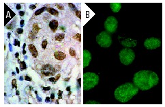 RCC1 (N-19): sc-1161. Immunoperoxidase staining of formalin-fixed, paraffin-embedded human colon carcinoma tissue (A) and Immunofluorescence staining of methanol-fixed NIH/3T3 cells (B) showing nuclear localization.