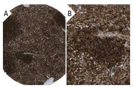 REP-1 (2F1): sc-23905. Immunoperoxidase staining of formalin fixed, paraffin-embedded human spleen tissue showing cytoplasmic staining of cells in red and white pulp (low and high magnification). Kindly provided by The Swedish Human Protein Atlas (HPA) program.