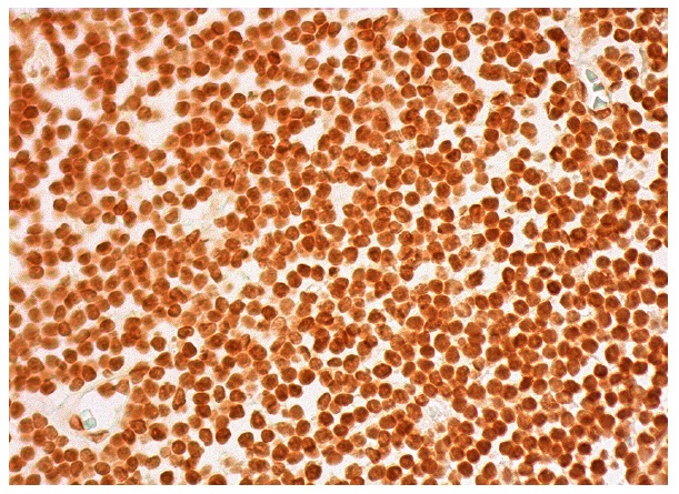 p-Rho A (Ser 188): sc-32954. Immunoperoxidase staining of formalin fixed, paraffin-embedded human lymph node tissue showing nuclear staining of cells in germinal centers and cells in non-germinal centers.