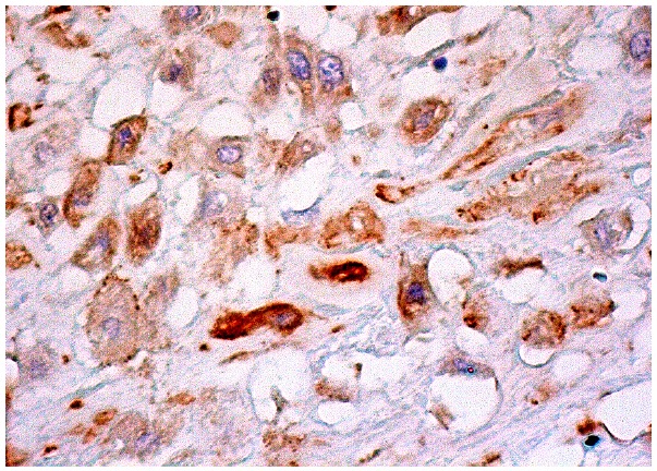 IL-8RA/B (H-100): sc-30008. Immunoperoxidase staining of formalin fixed, paraffin-embedded human placenta tissue showing cytoplasmic staining of decidual cells.