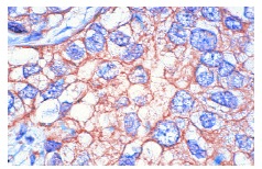 Neu (F-11): sc-7301. Immunoperoxidase staining of formalin-fixed, paraffin-embedded human breast carcinoma tissue showing membrane staining.