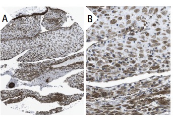 PTH/PTHrP-R (3D1.1): sc-12722. Immunoperoxidase staining of formalin fixed, paraffin-embedded human placenta tissue showing cytoplasmic staining of decidual and trophoblastic cells (low and high magnification). Kindly provided by The Swedish Human Protein Atlas (HPA) program.
