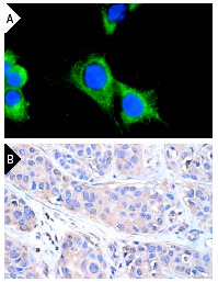 PDGFR-β (P-20): sc-339. Immunofluorescence staining of methanol-fixed NIH/3T3 cells (A). Note membrane and cytoplasmic fluorescein immunostaining and nuclear DAPI counterstain. Immunoperoxidase staining of formalin-fixed, paraffin-embedded human breast carcinoma tissue at high magnification (B) showing membrane and cytoplasmic localization.