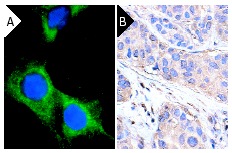 PDGFR-β (P-20): sc-339. Immunofluorescence staining of methanol-fixed NIH/3T3 cells (A). Note membrane and cytoplasmic fluorescein immunostaining and nuclear DAPI counterstain. Immunoperoxidase staining of formalin-fixed, paraffin-embedded human breast carcinoma tissue at high magnification (B) showing membrane and cytoplasmic localization.