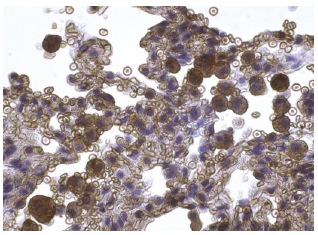 LIF (N-18): sc-1336. Immunoperoxidase staining of formalin fixed, paraffin-embedded human lung tissue showing cytoplasmic and membrane staining of macrophages and pneumocytes cells.