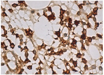 LITAF (D-5): sc-166546. Immunoperoxidase staining of formalin fixed, paraffin-embedded human bone marrow tissue showing membrane and cytoplasmic staining of hematopoietic cells.