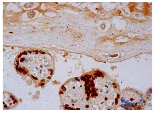 A cyclase I (V-20): sc-586. Immunoperoxidase staining of formalin fixed, paraffin-embedded human placenta tissue showing cytoplasmic and nuclear staining of trophoblastic cells and decidual cells.