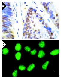 AKAP 95 (R-20): sc-6447. Immunoperoxidase staining of formalin-fixed, paraffin-embedded normal human colon carcinoma tissue (A) and immunofluorescence staining of methanol-fixed 3611-RF cells (B) showing nuclear localization.