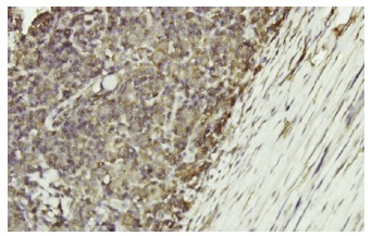 α Enolase (L-27): sc-100812. Immunoperoxidase staining of formalin-fixed, paraffin-embedded human lymphoma tissue showing membrane and cytoplasmic localization.