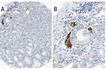 α-2M (2D9): sc-69750. Immunoperoxidase staining of formalin fixed, paraffin-embedded human stomach tissue showing distinct staining of blood plasma (low and high magnification). Kindly provided by The Swedish Human Protein Atlas (HPA) program.