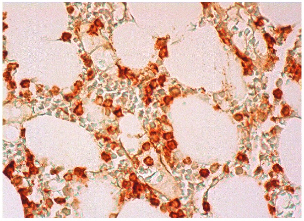 IL-1β (M-20): sc-1251. Immunoperoxidase staining of formalin fixed, paraffin-embedded human bone marrow tissue showing cytoplasmic and membrane staining of subset of hematopoietic cells.
