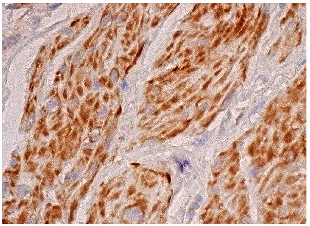 ATIII (C-18): sc-32453. Immunoperoxidase staining of formalin fixed, paraffin-embedded human smooth muscle tissue showing cytoplasmic staining of smooth muscle cells.