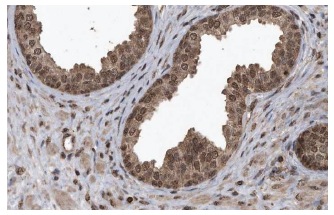CRYZL1 (C-20): sc-83233. Immunoperoxidase staining of formalin fixed, paraffin-embedded human prostate showing nuclear and cytoplasmic staining of glandular cells at high magnification. Kindly provided by The Swedish Human Protein Atlas (HPA) program.