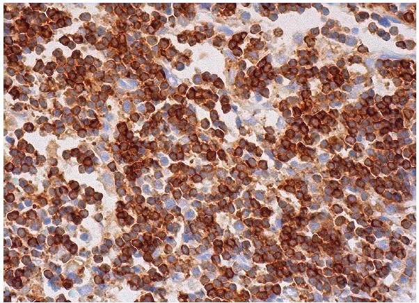 EVL (B-1): sc-376943. Immunoperoxidase staining of formalin fixed, paraffin-embedded human lymph node tissue showing cytoplasmic and membrane staining of cells in germinal and non-germinal centers.