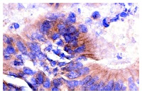 Integrin β4 (H-101): sc-9090. Immunoperoxidase staining of formalin-fixed, paraffin-embedded human colon tumor showing membrane and cytoplasmic staining.