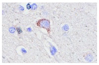 GDNF (D-20): sc-328. Immunoperoxidase staining of formalin-fixed, paraffin-embedded human brain tumor showing cytoplasmic staining.