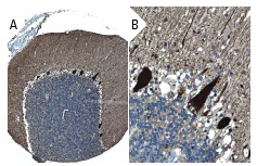 GDNF (D-20): sc-328. Immunoperoxidase staining of formalin fixed, paraffin-embedded human cerebellum tissue showing cytoplasmic staining in cells at granular and molecular layers, and cytoplasmic and nuclear staining in Purkinje cells (low and high magni?fication). Kindly provided by The Swedish Human Protein Atlas (HPA) program.