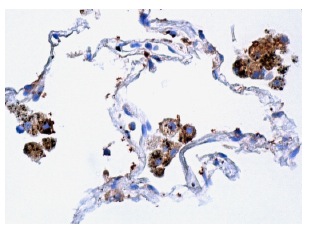Laminin-R (H-2): sc-74515. Immunoperoxidase staining of formalin fixed, paraffin-embedded human lung tissue showing cytoplasmic staining of macrophages.